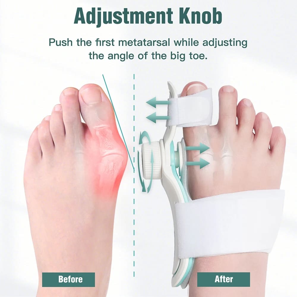 Korektor bunion ortopedi, korektor hallux valgus pada kaki